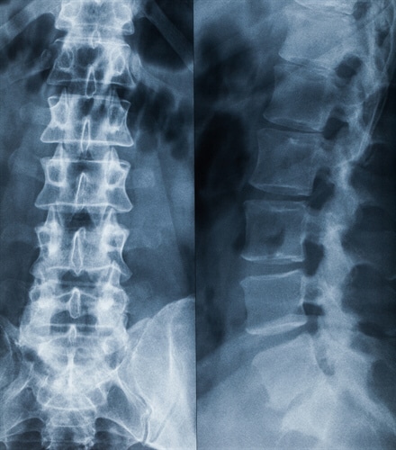 Type 2 Diabetes Drugs and Bone Breaks